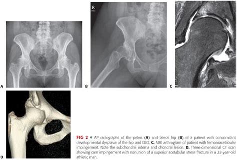 left total hip arthroplasty icd 10|icd 10 code left hip arthroplasty revision.